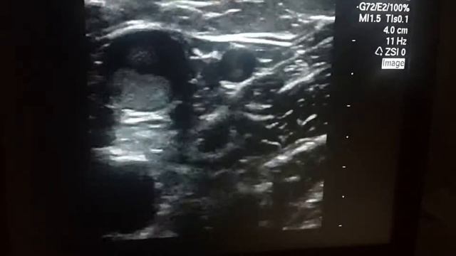 Удвоение большой подкожной вены смотреть онлайн