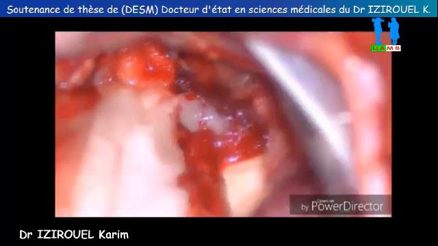 Soutenance de thèse de doctorat en Sciences Médicales, par: Dr IZIROUEL Karim, CHU-Bejaia, speech, смотреть онлайн