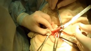 How does appendicitis look like?Как выглядит аппендицит?