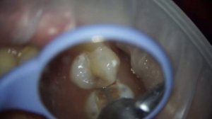 чистим кариес зуба #стоматология #кариес #пломба #стоматолог #виниры #имплант