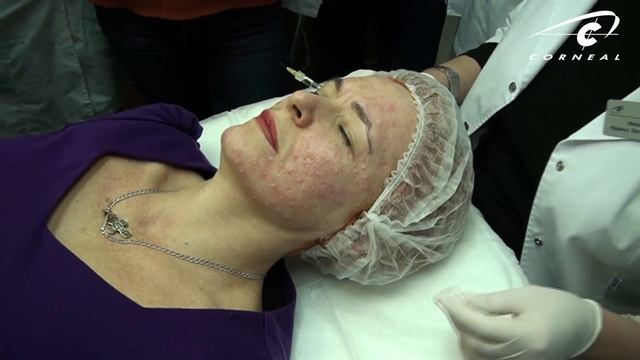 Стоит ли истончать плотную кожу? смотреть онлайн