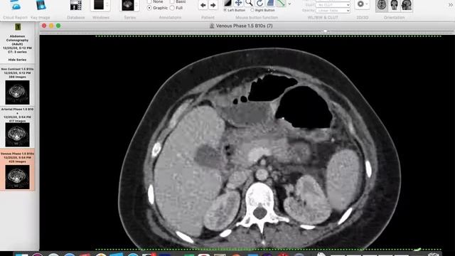 | GIT | Emergency | Post CS Acute perforated appendicitis and paralytic ilius. смотреть онлайн