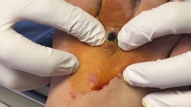 Guess What Popped Out of this Foot! By Podiatrist Dr. Binh Nguyen смотреть онлайн