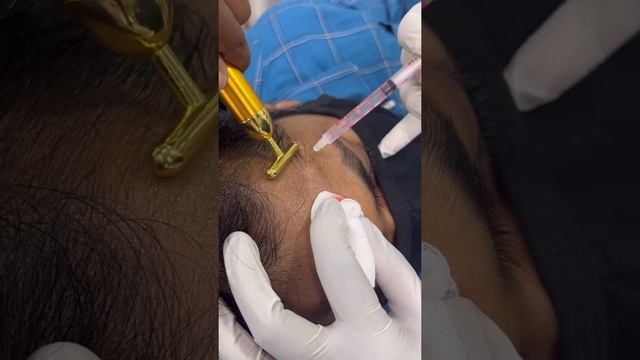 PRP Injections For Hair Growth #shorts