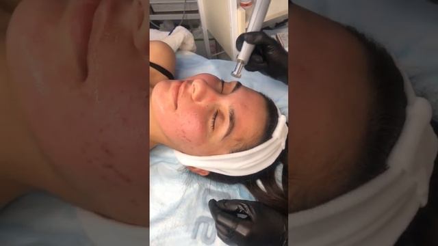 Фракционная насадка аппарат Ablase. «Па-а-ама-гите!» смотреть онлайн