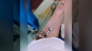 Как снимают аппарат илизарова слабонервных убрать от экрана