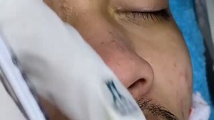 Relaxing Acne Treatment Acnes Treatment  128