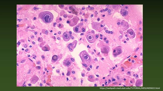 Cytomegalovirus (CMV) смотреть онлайн