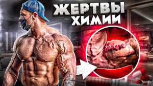 КАЧКОВЫЙ ВАРИКОЗ! СТЕРОИДНЫЕ ВЕНЫ И ПОСЛЕДСТВИЯ