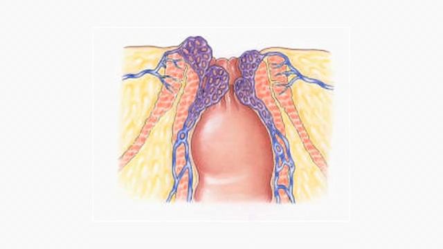 Hurting From Hemorrhoids смотреть онлайн