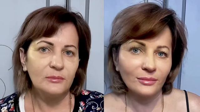 Результат нитевого лифтинга смотреть онлайн