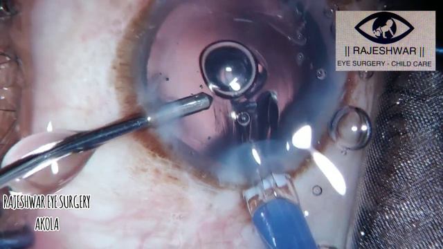 DEFLORATION OF A LENS INJECTOR CARTRIDGE смотреть онлайн