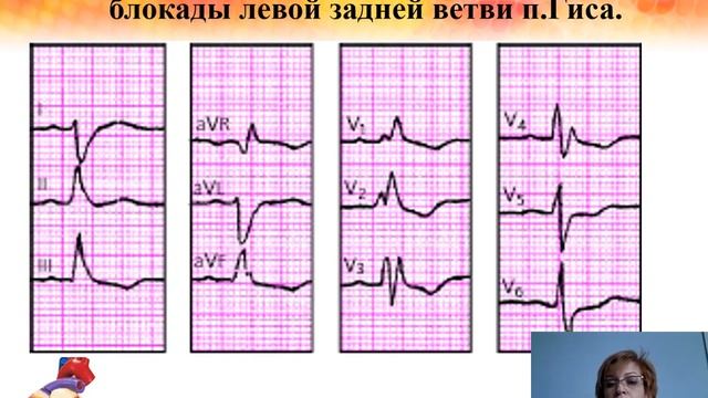 ЭКГ. Блокады (часть 2). Максимцева Е.А. смотреть онлайн