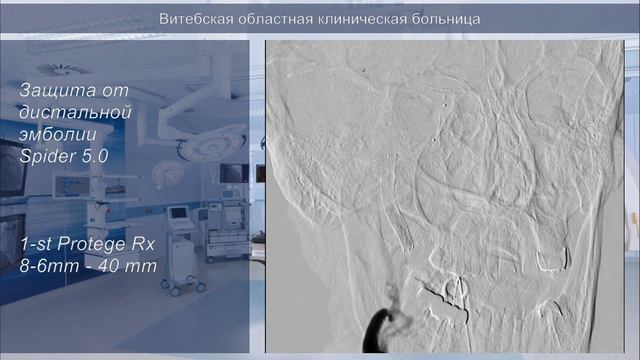 РЭВХ ВОКБ 001 диссекция ВСА смотреть онлайн
