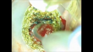 Лазерная вапоризация шейки матки .