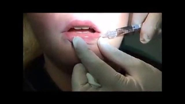 DioDent - увеличение объема и коррекция формы губ с помощью филлеров смотреть онлайн