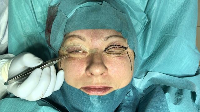 Пластический хирург Константин Клименко. Блефаропластика верхних век. смотреть онлайн