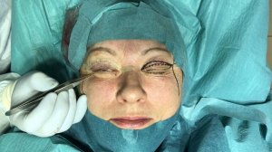 Пластический хирург Константин Клименко. Блефаропластика верхних век.