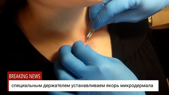 Установка микродермала смотреть онлайн