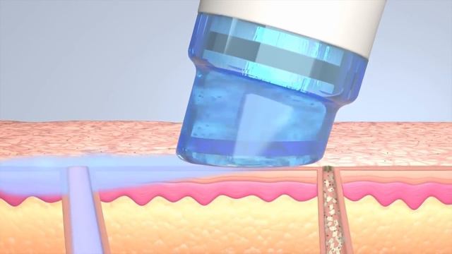 Hydrafacial смотреть онлайн