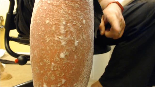 NON-TOXIC GLUE vs Psoriasis! смотреть онлайн