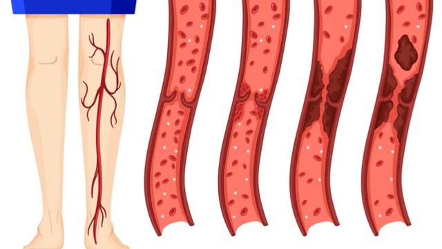 Не хочешь тромбов - пей этот напиток смотреть онлайн