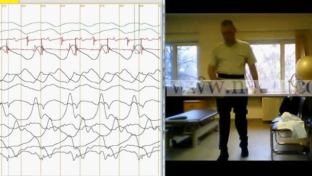 Гемипарез справа