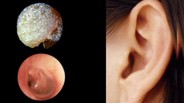 Серные пробки#лорврач#медицина#кмв смотреть онлайн