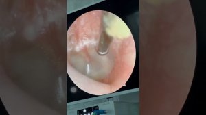 Парацентез барабанная перепонка