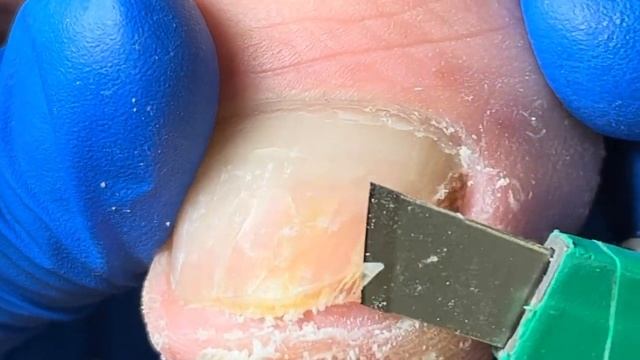Pedicure Tutorial: Quick Trimming Of Giant Ingrown Toenails!【Xue Yidao Pedicure】