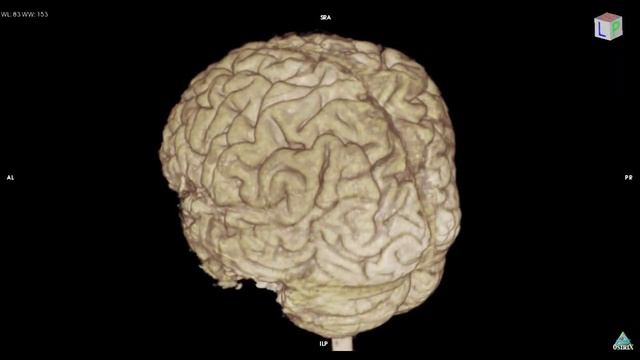 Variation of brain cortex 3D MRI sample F,]ot смотреть онлайн