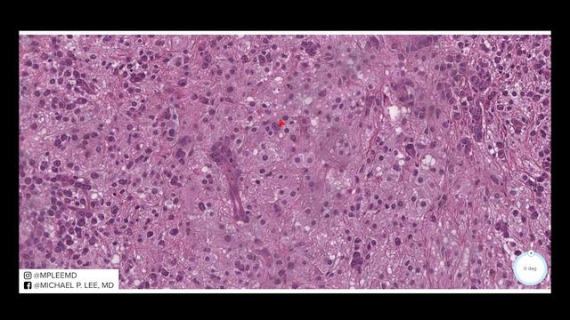 Rosai-Dorfman Disease. Dermpath made easy. Explained by a dermatopathologist. смотреть онлайн