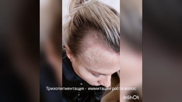 трихопигментация имитация роста волос смотреть онлайн