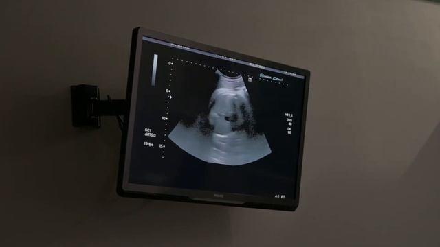 УЗИ перед родами смотреть онлайн