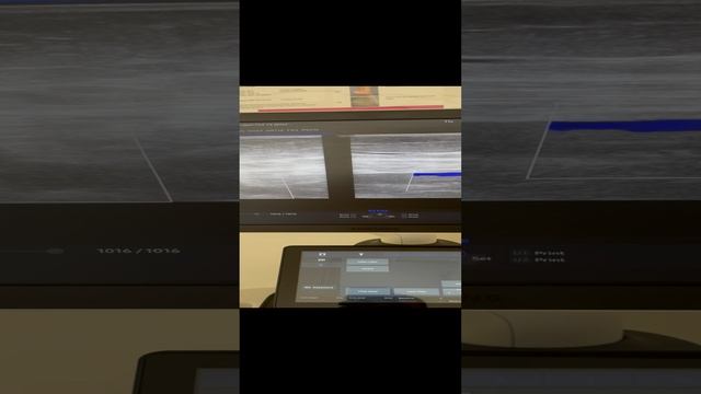 Упустили тромб. Тромб оторвался. Пациентка в реанимации. Флеболог Москва смотреть онлайн