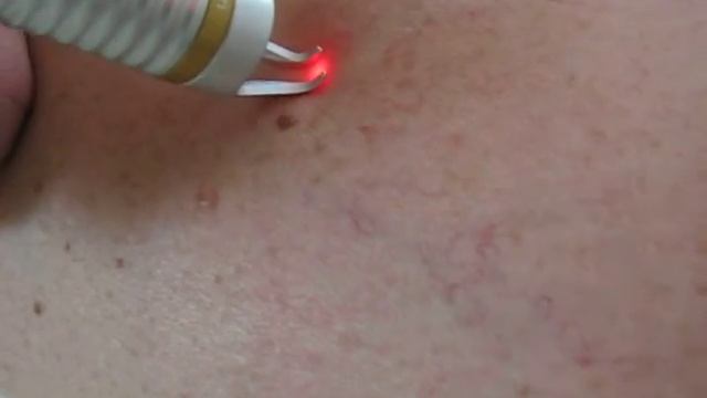 Лазерна абляція черезшкірна смотреть онлайн