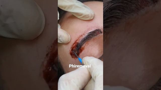 #phiremoval #erbil#ankawa #dan tattoo salon