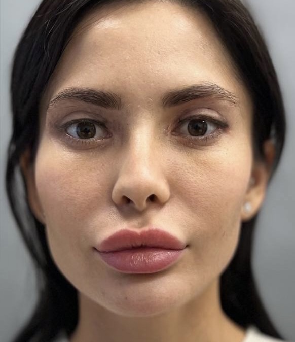 Трансконъюктивальная блефаропластика. Результат спустя неделю.