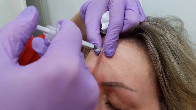 Аириском: практика студентов введение БОТОКСА горизонтальные морщины ЛБА смотреть онлайн