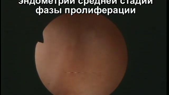 Непроходимость маточных труб. смотреть онлайн