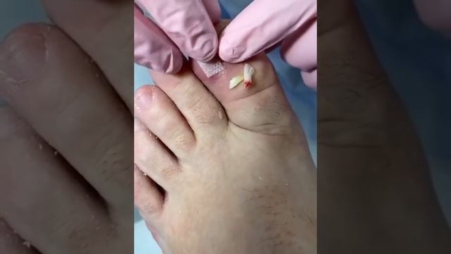 Вросший Ноготь часть 2
