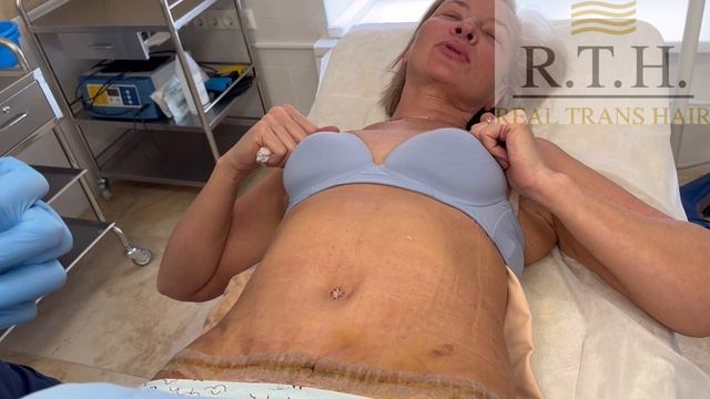 Абдоминопластика смотреть онлайн