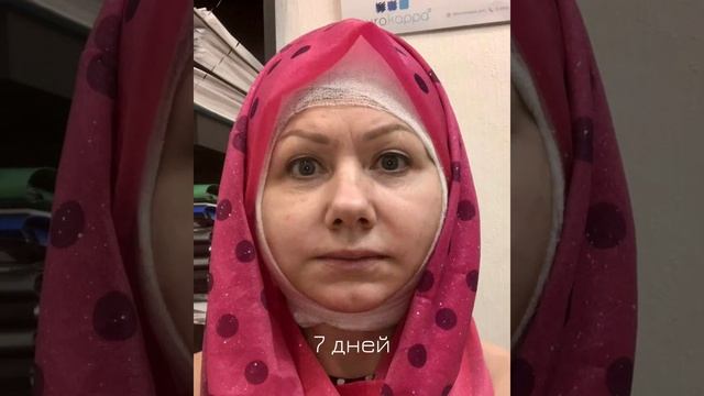 Реабилитация 14 дней после SMAS лифтинга. Как это выглядит. От и до смотреть онлайн