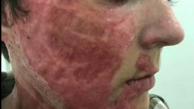 THE ORDINARY CHEMICAL PEEL FULL REVIEW | HOW TO USE THE 30% AHA 2% BHA PEELING SOLUTION смотреть онлайн