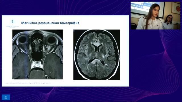 Демиелинизирующий неврит зрительного нерва ч.1