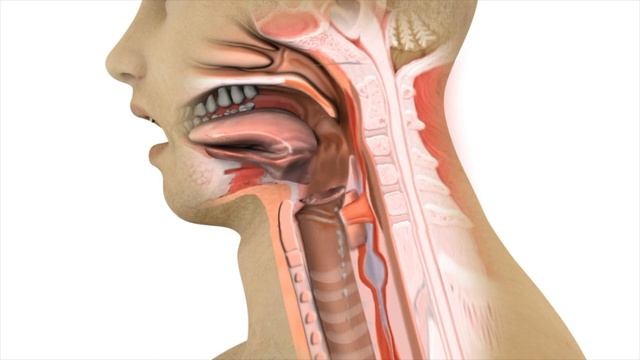 Cricopharyngeus Dysfunction (CPD) Causing Dysphagia or Trouble Swallowing смотреть онлайн