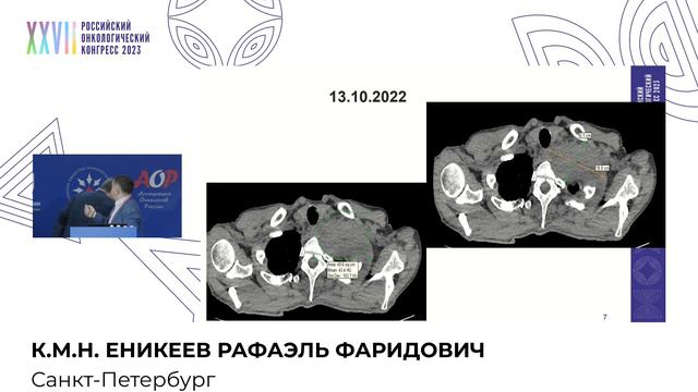 Диагностические ловушки. Редкая форма рака легкого. Онколог смотреть онлайн
