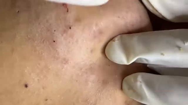 Relaxing Acne Treatment Acnes Treatment  129