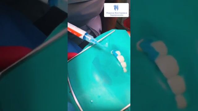 Скол зуба смотреть онлайн