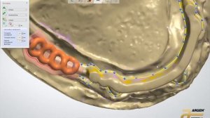 Съемный протез на балке | ЗУБНОЙ ТЕХНИК